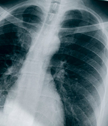 Imagen de una radiografía de tórax